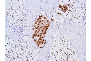 Immunohistochemistry of Human Prostate Adenocarcinoma stained with anti-Androgen Receptor (AR) antibody (Androgen Receptor 抗体  (N-Term))
