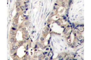 Immunohistochemistry of paraffin-embedded Human breast carcinoma using Phospho-ABL1(Y412) Polyclonal Antibody (ABL1 抗体  (pTyr412))