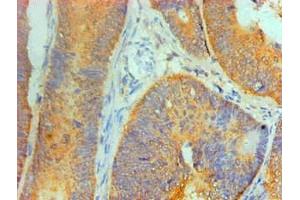 Immunohistochemical of paraffin-embedded Human Colon cancer tissue using ABIN7156047 at dilution of 1:200. (IL1A 抗体)