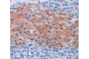 IHC-P analysis of Human Liver Cancer Tissue, with DAB staining. (MUC2 抗体  (AA 5075-5179))