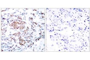 Immunohistochemical analysis of paraffin-embedded human breast carcinoma tissue using STAT5A (Ab-694) antibody (E021048). (STAT5A 抗体)