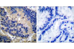 Cl-peptide - +Immunohistochemical analysis of paraffin-embedded human lung carcinoma tissue using Caspase 3 (cleaved-Asp175) antibody. (Caspase 3 抗体  (Cleaved-Asp175))