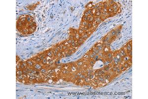 Immunohistochemistry of Human cervical cancer using MMP1 Polyclonal Antibody at dilution of 1:55 (MMP1 抗体)