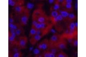Immunofluorescence analysis of Human stomach cancer tissue using Ubiquitin Monoclonal Antibody at dilution of 1:200. (Ubiquitin 抗体)