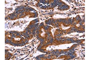 The image on the left is immunohistochemistry of paraffin-embedded Human colon cancer tissue using ABIN7129993(KIR2DL3/KIR2DL1/KIR2DL4/KIR2DS4 Antibody) at dilution 1/30, on the right is treated with fusion protein. (KIR2DL3/KIR2DL1/KIR2DL4/KIR2DS4 抗体)