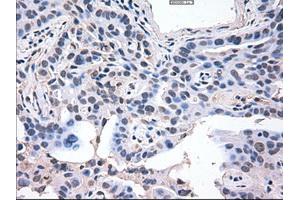 Immunohistochemical staining of paraffin-embedded Carcinoma of lung using anti-AKT3 (ABIN2452682) mouse monoclonal antibody. (AKT3 抗体  (AA 2-479))
