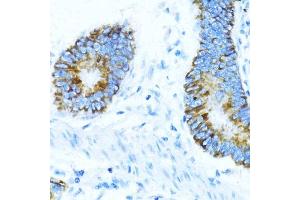 Immunohistochemistry of paraffin-embedded human colon carcinoma using NOX1 antibody (ABIN7268824) at dilution of 1:100 (40x lens). (NOX1 抗体  (AA 200-300))