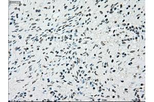 Immunohistochemical staining of paraffin-embedded Adenocarcinoma of breast tissue using anti-BRAF mouse monoclonal antibody. (BRAF 抗体)