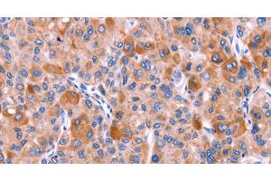 Immunohistochemistry of paraffin-embedded Human liver cancer tissue using GCG Polyclonal Antibody at dilution 1:40 (Glucagon 抗体)