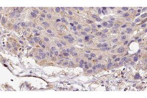 ABIN6279108 at 1/100 staining Human melanoma tissue by IHC-P. (alpha 2 Antiplasmin 抗体  (C-Term))