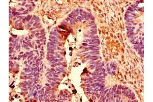 Immunohistochemistry of paraffin-embedded human ovarian cancer using ABIN7150430 at dilution of 1:100 (POLR2C 抗体  (AA 2-275))