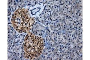 Immunohistochemical staining of paraffin-embedded Adenocarcinoma of colon tissue using anti-HSD17B10mouse monoclonal antibody. (HSD17B10 抗体)