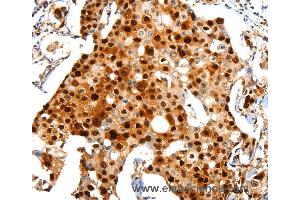 Immunohistochemistry of Human breast cancer using PCNA Polyclonal Antibody at dilution of 1:44 (PCNA 抗体)