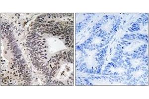 Immunohistochemistry analysis of paraffin-embedded human colon carcinoma, using WWOX (Phospho-Tyr33) Antibody. (WWOX 抗体  (pTyr33))