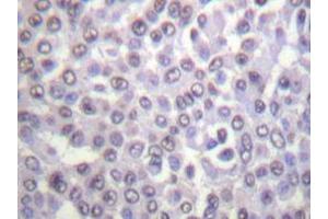 Immunohistochemistry analyzes of Histone H4 antibody in paraffin-embedded human breast carcinoma tissue. (Histone H4 抗体)