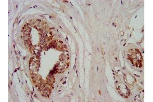 IHC image of ABIN7160564 diluted at 1:400 and staining in paraffin-embedded human breast cancer performed on a Leica BondTM system. (MYH11 抗体  (AA 1655-1797))