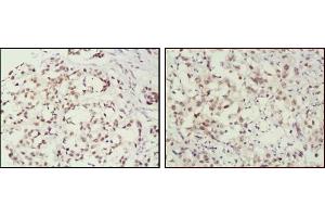 Immunohistochemical analysis of paraffin-embedded human breast cancer (left) and lung cancer (right) tissues, showing nuclear localization using MSH2 antibody with DAB staining. (MSH2 抗体)