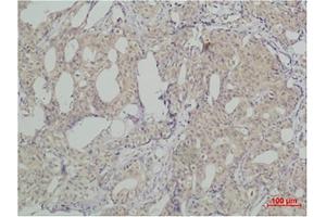 Immunohistochemical analysis of paraffin-embedded human breast caricnoma using SLUG Polyclonal Antibody. (SLUG 抗体)