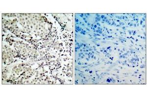 Immunohistochemical analysis of paraffin- embedded human breast carcinoma tissue, using MKK3 (Ab-189) antibody (E021116). (MAP2K3 抗体)