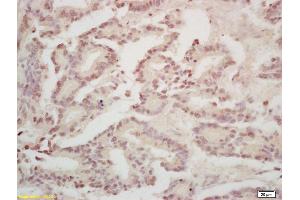 Formalin-fixed and paraffin embedded human gastric carcinoma labeled with Rabbit Anti Annexin A13 Polyclonal Antibody, Unconjugated (ABIN1714416) at 1:200 followed by conjugation to the secondary antibody and DAB staining (CRY1 抗体)