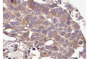 ABIN6267636 at 1/100 staining human breast carcinoma tissue sections by IHC-P. (G3BP1 抗体  (pSer232))
