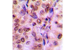 Immunohistochemical analysis of IRS1 staining in human breast cancer formalin fixed paraffin embedded tissue section. (IRS1 抗体  (Center))