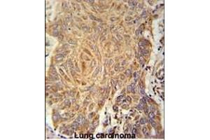 PCYXL Antibody (C-term) (ABIN651800 and ABIN2840404) immunohistochemistry analysis in formalin fixed and paraffin embedded human Lung carcinoma followed by peroxidase conjugation of the secondary antibody and DAB staining. (PCYOX1L 抗体  (C-Term))