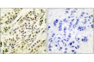 Immunohistochemistry analysis of paraffin-embedded human breast carcinoma tissue, using SKP1A/p19 Antibody. (SKP1 抗体  (AA 41-90))