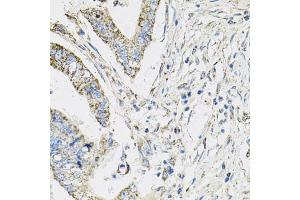 Immunohistochemistry of paraffin-embedded human colon carcinoma using PIK3CB antibody (ABIN5970370) at dilution of 1/100 (40x lens). (PIK3CB 抗体)