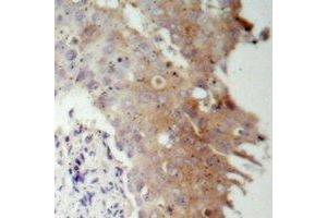 Immunohistochemical analysis of IRS1 staining in human prostate cancer formalin fixed paraffin embedded tissue section. (IRS1 抗体)