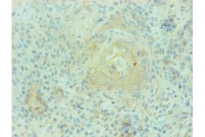 Immunohistochemical of paraffin-embedded human breast cancer using ABIN7168560 at dilution of 1:200 (S1A9 抗体)