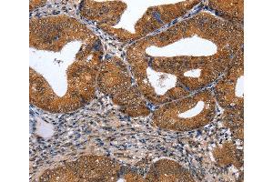 Immunohistochemistry of Human cervical cancer using GATA6 Polyclonal Antibody at dilution of 1:35 (GATA6 抗体)