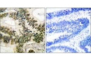 Immunohistochemistry analysis of paraffin-embedded human colon carcinoma tissue, using Cyclin E1 (Ab-395) Antibody. (Cyclin E1 抗体  (AA 361-410))