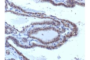 Formalin-fixed, paraffin-embedded human Thyroid Carcinoma stained with TSHRA Monoclonal Antibody (SPM223). (TSH receptor 抗体)