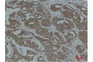 Immunohistochemistry (IHC) analysis of paraffin-embedded Human Breast Carcinoma using Calnexin Polyclonal Antibody. (Calnexin 抗体)