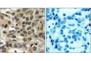 Immunohistochemistry analysis of paraffin-embedded human breast carcinoma tissue, using CDC25C (Ab-216) Antibody. (CDC25C 抗体  (AA 183-232))