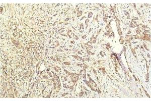 Immunohistochemistry of paraffin-embedded Human breast carcinoma tissue using STAT1 Monoclonal Antibody at dilution of 1:200. (STAT1 抗体)