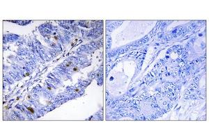 Immunohistochemistry analysis of paraffin-embedded human colon carcinoma tissue using Nuclear Receptor NR4A1 (Phospho-Ser351) antibody. (NR4A1 抗体  (pSer351))