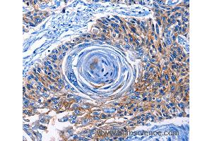 Immunohistochemistry of Human esophagus cancer using CLEC2B Polyclonal Antibody at dilution of 1:50 (CLEC2B 抗体)