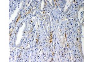 IHC testing of FFPE human colon cancer tissue with VEGFD antibody at 1ug/ml. (VEGFD (VEGF4) (AA 89-205) 抗体)