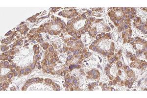 ABIN6279548 at 1/100 staining Human liver cancer tissue by IHC-P. (SLC16A9 抗体  (Internal Region))