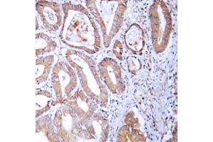 Immunohistochemical analysis of MRPL24 staining in human colon cancer formalin fixed paraffin embedded tissue section. (MRPL24 抗体  (Center))