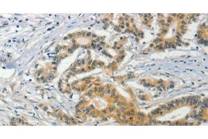 Immunohistochemistry of paraffin-embedded Human colon cancer tissue using ASB8 Polyclonal Antibody at dilution 1:50 (ASB8 抗体)