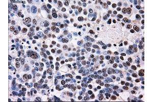 Immunohistochemical staining of paraffin-embedded Adenocarcinoma of colon tissue using anti-ID3mouse monoclonal antibody. (ID3 抗体)