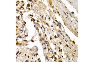 Immunohistochemistry of paraffin-embedded human colon damage using DP1/DP1/TFDP1 antibody (ABIN6130313, ABIN6149038, ABIN6149040 and ABIN6221075) at dilution of 1:200 (40x lens). (DP1 抗体  (AA 1-290))