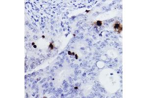 Immunohistochemistry of paraffin-embedded human colon carcinoma using Phospho-Histone H3-S10 Rabbit pAb (ABIN7267687) at dilution of 1:2000 (40x lens). (Histone 3 抗体  (H3S10p))