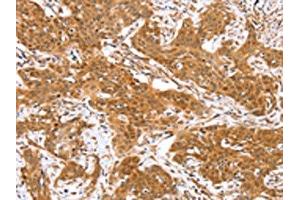 The image on the left is immunohistochemistry of paraffin-embedded Human cervical cancer tissue using ABIN7130874(RGS22 Antibody) at dilution 1/40, on the right is treated with fusion protein. (RGS22 抗体)