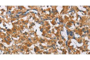 Immunohistochemistry of paraffin-embedded Human thyroid cancer using COPB1 Polyclonal Antibody at dilution of 1:50 (COPB1 抗体)