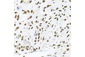 Immunohistochemistry of paraffin-embedded human lung cancer using MAPK8 antibody at dilution of 1:100 (x40 lens). (JNK 抗体)
