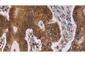 Immunohistochemistry of paraffin-embedded Human colon cancer tissue using ERCC6L Polyclonal Antibody at dilution 1:30 (ERCC6L 抗体)